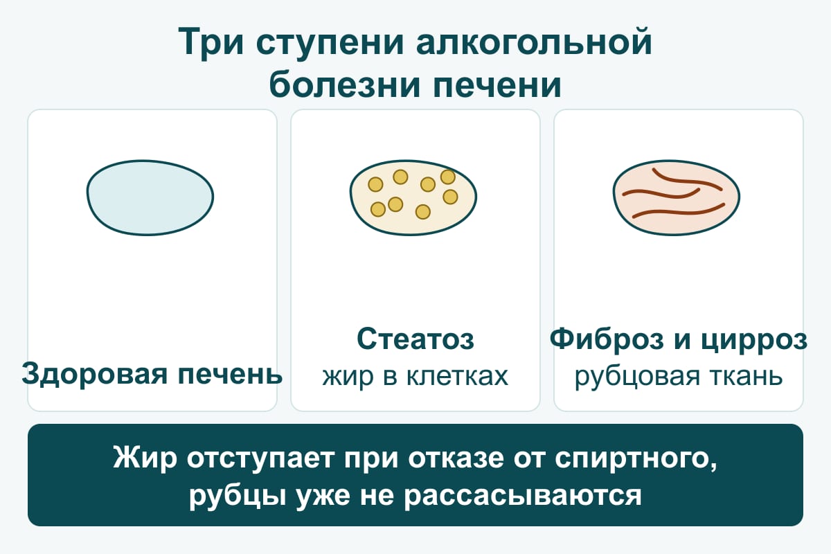 Схема: три силуэта печени — здоровая, стеатоз с жировыми включениями, фиброз и цирроз с рубцовой тканью